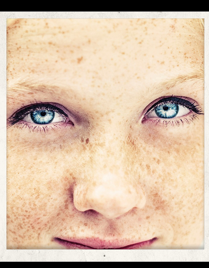 La pigmentation sur la personne après 50